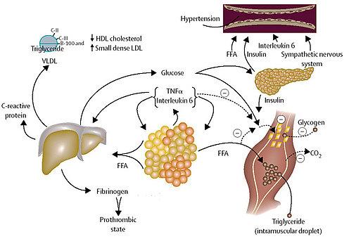 Metabolic syndrome pathophysiology.