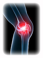 Osteoarthritis is a inflammation in joints.